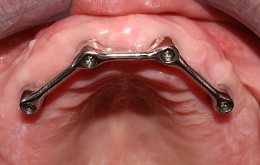 Zubní implantát a protéza 2